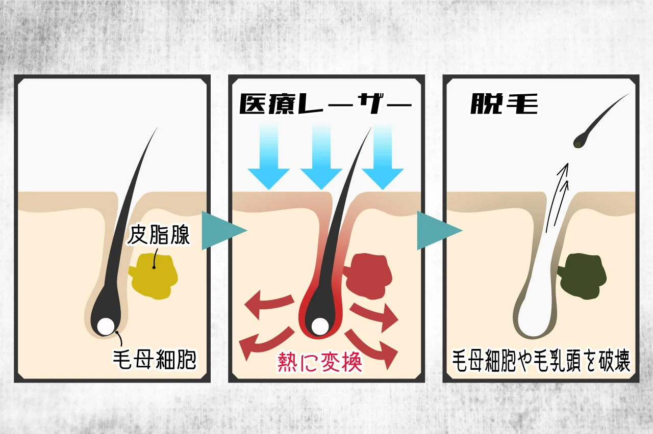 メンズ　医療脱毛　仕組み